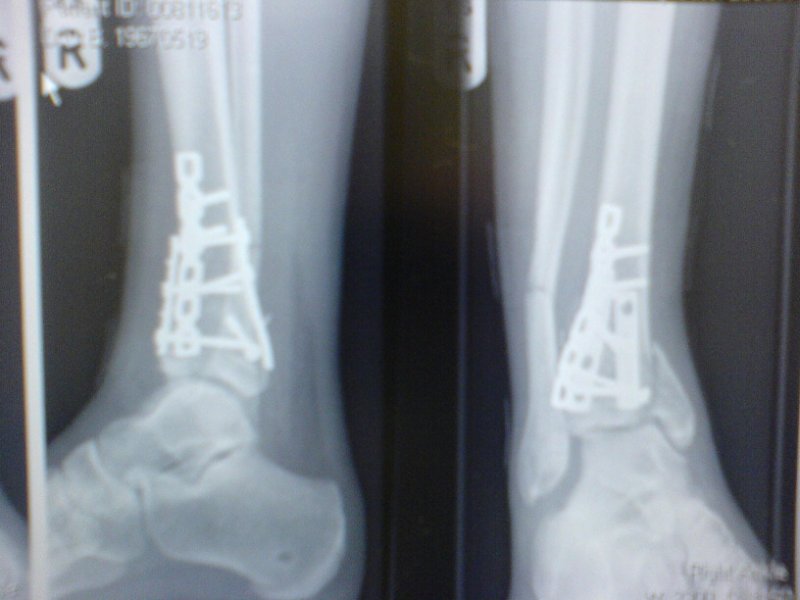 broken leg 3.JPG